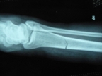 fractura flickr